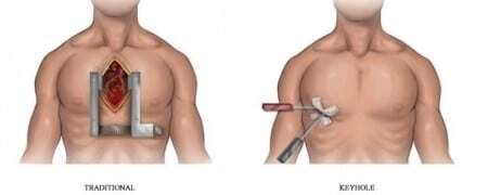keyhole heart surgery