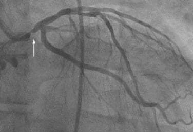Coronary Artery Disease Angiogram