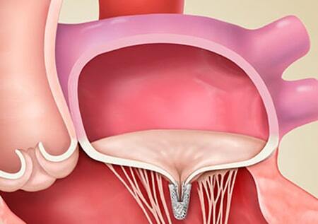 MitraClip Treatment For Leaky Mitral Valve Disease: Are You A Candidate?