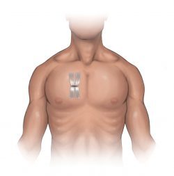 Closed chest