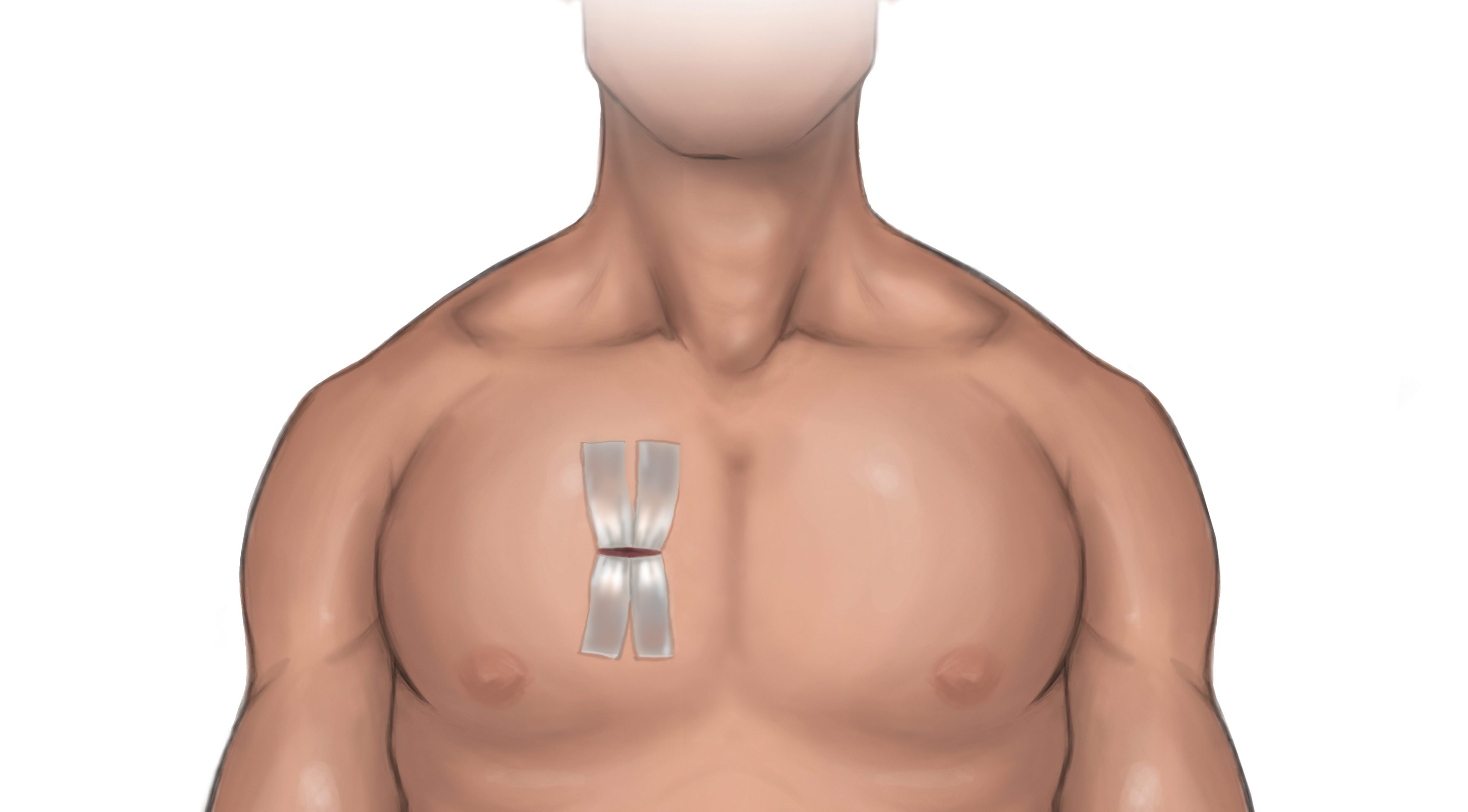 Aortic Regurgitation