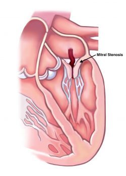 Mitral Stenosis
