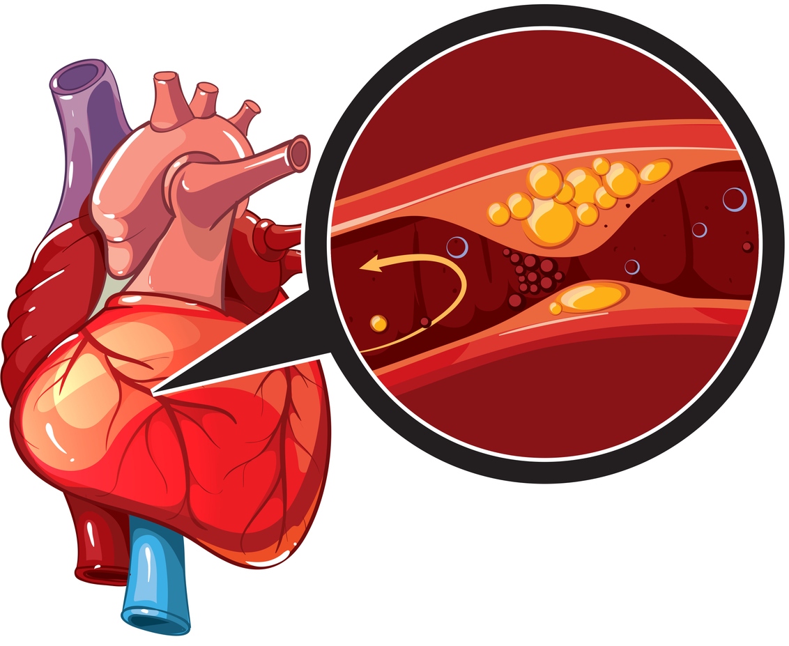 Myocardial infarction diagram
