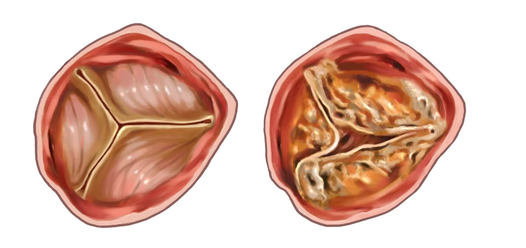 Aortic Valve Stenosis