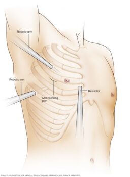 keyhole mitral surgery image