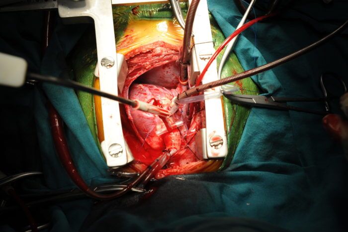 Keyhole Mitral Valve Surgery Vs Traditional Breastbone Surgery